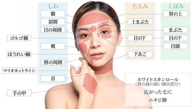 真皮線維芽細胞療法施術部位